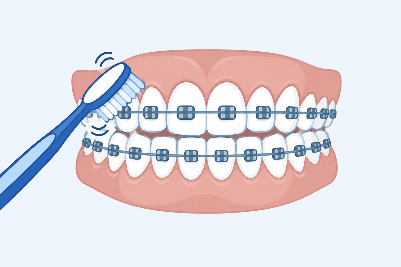 Illustration of a toothbrush angled against the brackets of the upper teeth
