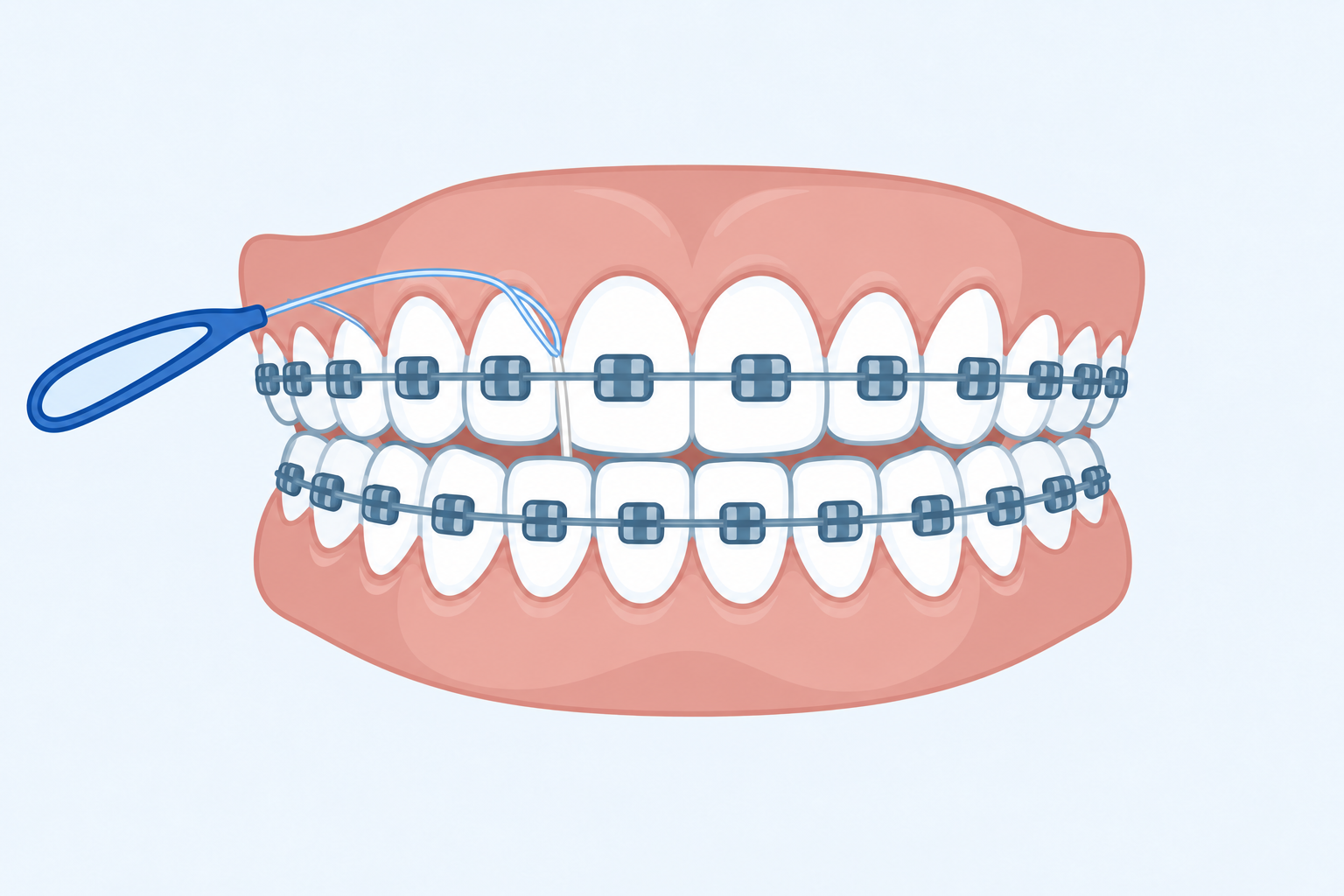 Illustration of floss threaded under the archwire between two teeth